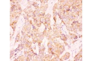 IHC-P: AAMP antibody testing of human breast cancer tissue (AAMP anticorps  (AA 235-434))