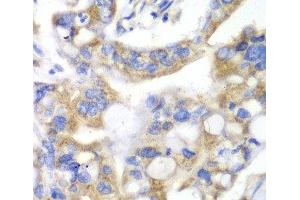 Immunohistochemistry of paraffin-embedded Human liver cancer using PNLIP Polyclonal Antibody at dilution of 1:100 (40x lens).