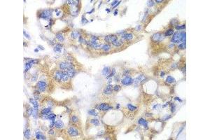 Immunohistochemistry of paraffin-embedded Human liver cancer using PNLIP Polyclonal Antibody at dilution of 1:100 (40x lens). (PNLIP anticorps)