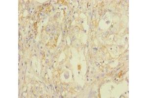 Immunohistochemistry of paraffin-embedded human lung cancer using ABIN7170802 at dilution of 1:100 (STOML2 anticorps  (AA 29-356))