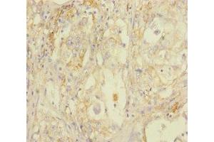 Immunohistochemistry of paraffin-embedded human lung cancer using ABIN7170802 at dilution of 1:100