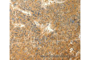 Immunohistochemistry of Human thyroid cancer using RAB35 Polyclonal Antibody at dilution of 1:40