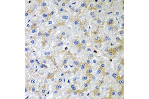 Immunohistochemistry of paraffin-embedded human liver injury using SRGN antibody at dilution of 1:200 (40x lens). (SRGN anticorps)