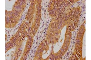 IHC image of ABIN7139700 diluted at 1:100 and staining in paraffin-embedded human colon cancer performed on a Leica BondTM system.