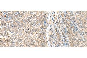 Immunohistochemistry of paraffin-embedded Human liver cancer tissue using ASS1 Polyclonal Antibody at dilution of 1:35(x200)