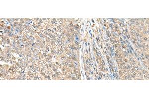 Immunohistochemistry of paraffin-embedded Human liver cancer tissue using ASS1 Polyclonal Antibody at dilution of 1:35(x200) (ASS1 anticorps)