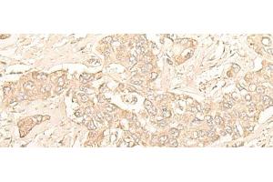 Immunohistochemistry of paraffin-embedded Human liver cancer tissue using DIMT1 Polyclonal Antibody at dilution of 1:30(x200) (DIMT1 anticorps)