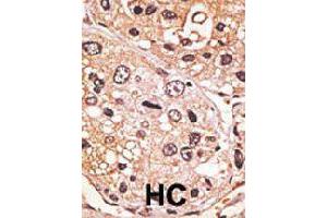 Formalin-fixed and paraffin-embedded human hepatocellular carcinoma tissue reacted with GDF9 polyclonal antibody  , which was peroxidase-conjugated to the secondary antibody, followed by AEC staining. (GDF9 anticorps  (N-Term))