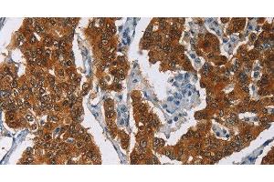 Immunohistochemistry of paraffin-embedded Human breast cancer tissue using CRABP2 Polyclonal Antibody at dilution 1:40