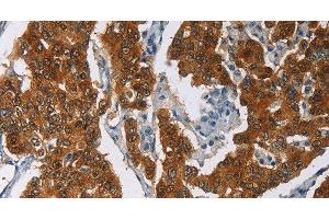 Immunohistochemistry of paraffin-embedded Human breast cancer tissue using CRABP2 Polyclonal Antibody at dilution 1:40 (CRABP2 anticorps)