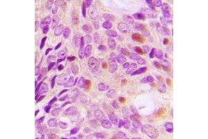 Immunohistochemical analysis of DLGAP5 staining in human breast cancer formalin fixed paraffin embedded tissue section.