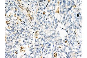 ABIN6262287 and ABIN6276673 at 1/100 staining Human ovarian cancer by IHC-P.