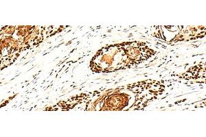 Immunohistochemistry of paraffin-embedded Human esophagus cancer tissue using H1FX Polyclonal Antibody at dilution of 1:30(x200) (H1FX anticorps)
