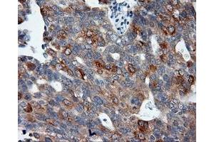 Immunohistochemical staining of paraffin-embedded Adenocarcinoma of colon tissue using anti-SIL1 mouse monoclonal antibody. (SIL1 anticorps)