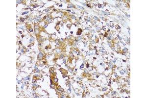 Immunohistochemistry of paraffin-embedded Human uterine cancer using ACTR2 Polyclonal Antibody at dilution of 1:100 (40x lens). (ACTR2 anticorps)