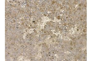 ABIN6255046 and ABIN6267160 at 1/100 staining human melanoma by IHC-P. (PRAS40 anticorps  (pSer183))