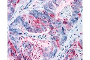 Anti-GPR82 antibody IHC of human Colon, Carcinoma.