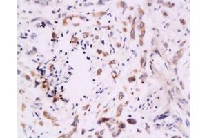 Formalin-fixed and paraffin embedded human colon carcinoma labeled Anti-B7H4 Polyclonal Antibody, Unconjugated  at 1:200, followed by conjugation to the secondary antibody and DAB staining