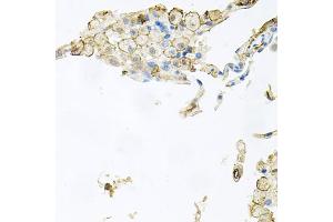 Immunohistochemistry of paraffin-embedded human lung injury using AIF1 antibody (ABIN5970719) at dilution of 1/100 (40x lens). (Iba1 anticorps)
