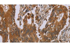 Immunohistochemistry of paraffin-embedded Human colon cancer tissue using OSM Polyclonal Antibody at dilution 1:40 (Oncostatin M anticorps)