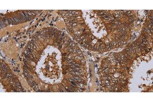 Immunohistochemistry of paraffin-embedded Human colon cancer tissue using WDR83 Polyclonal Antibody at dilution 1:60 (MORG1 anticorps)