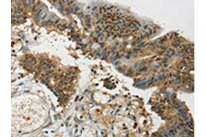 The image on the left is immunohistochemistry of paraffin-embedded Human colon cancer tissue using ABIN7192709(SYCP1 Antibody) at dilution 1/35, on the right is treated with synthetic peptide. (SYCP1 anticorps)