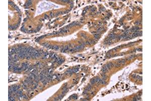 The image on the left is immunohistochemistry of paraffin-embedded Human colon cancer tissue using ABIN7130954(S100A13 Antibody) at dilution 1/40, on the right is treated with fusion protein. (S100A13 anticorps)