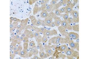 Immunohistochemistry of paraffin-embedded Human liver damage using POMGNT1 Polyclonal Antibody at dilution of 1:100 (40x lens).