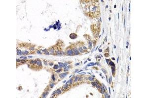 Immunohistochemistry of paraffin-embedded Human stomach cancer using FABP3 Polyclonal Antibody at dilution of 1:200 (40x lens). (FABP3 anticorps)