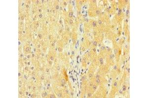 Immunohistochemistry of paraffin-embedded human liver cancer using ABIN7163953 at dilution of 1:100 (Kv1.6/KCNA6 anticorps  (AA 1-171))
