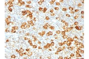 Formalin-fixed, paraffin-embedded human Hodgkin's Lymphoma stained with CD30 Rabbit Recombinant Monoclonal Antibody (Ki-1/1505R). (Recombinant TNFRSF8 anticorps)