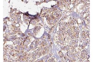 ABIN6275436 at 1/100 staining Human breast cancer tissue by IHC-P. (RAB3GAP2 anticorps  (Internal Region))