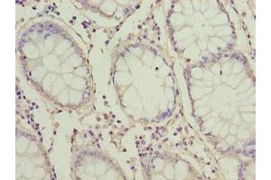 Immunohistochemistry of paraffin-embedded human colon cancer using ABIN7166380 at dilution of 1:100 (ZNF767P anticorps  (AA 1-118))