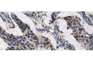 Immunohistochemistry of paraffin-embedded Human breast cancer tissue using COL17A1 Polyclonal Antibody at dilution of 1:50(x200)