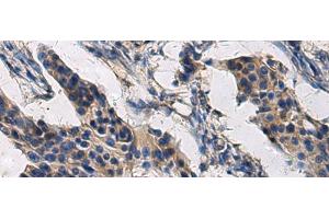 Immunohistochemistry of paraffin-embedded Human breast cancer tissue using COL17A1 Polyclonal Antibody at dilution of 1:50(x200)