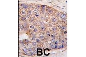 Formalin-fixed and paraffin-embedded human breast carcinoma tissue reacted with UBTD1 Antibody (C-term ) (ABIN387937 and ABIN2844471) , which was peroxidase-conjugated to the secondary antibody, followed by DAB staining. (UBTD1 anticorps  (C-Term))