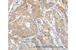 Immunohistochemistry of Human gastric cancer using APOBEC3G Polyclonal Antibody at dilution of 1:30 (APOBEC3G anticorps)