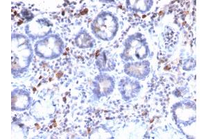 Formalin-fixed, paraffin-embedded human Gastric Carcinoma stained with MUC3 Rabbit Recombinant Monoclonal Antibody (MUC3/2992R). (Recombinant MUC3A anticorps)