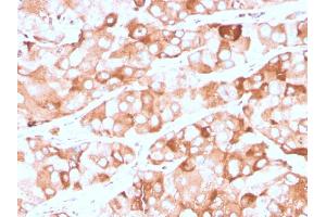 Formalin-fixed, paraffin-embedded human breast carcinoma stained with Prolactin Receptor Recombinant Mouse Monoclonal Antibody (rPRLR742). (Recombinant Prolactin Receptor anticorps)