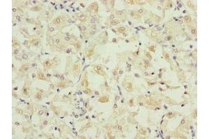 Immunohistochemistry of paraffin-embedded human gastric cancer using ABIN7162667 at dilution of 1:100 (PARD6B anticorps  (AA 253-372))