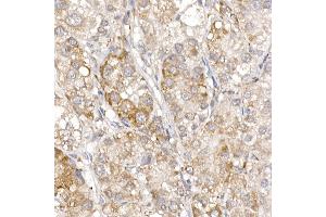 Immunohistochemistry of paraffin-embedded human liver cancer using Sterol carrier protein 2 Rabbit mAb (ABIN7270597) at dilution of 1:100 (40x lens).