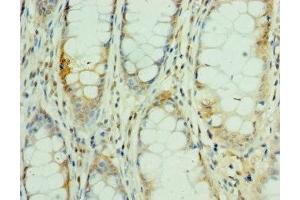 Immunohistochemistry of paraffin-embedded human colon cancer using ABIN7160505 at dilution of 1:100