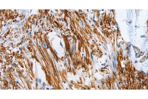 Immunohistochemistry of paraffin-embedded Human colon cancer tissue using SHROOM2 Polyclonal Antibody at dilution 1:50 (SHROOM2 anticorps)