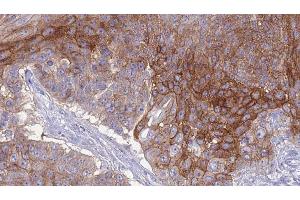 ABIN6276827 at 1/100 staining Human urothelial cancer tissue by IHC-P. (CEACAM1 anticorps  (C-Term))