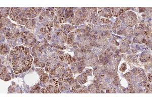ABIN6273283 at 1/100 staining Human pancreas cancer tissue by IHC-P. (LEPREL2 anticorps  (Internal Region))