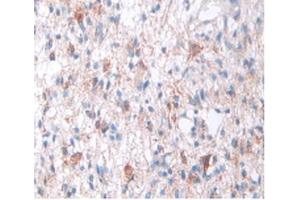 IHC-P analysis of Human Glioma Tissue, with DAB staining. (SOD2 anticorps  (AA 25-222))