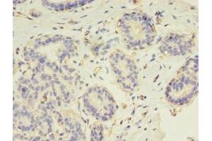Immunohistochemistry of paraffin-embedded human breast cancer using ABIN7147264 at dilution of 1:100