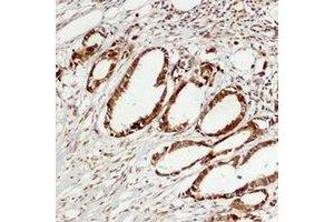 Immunohistochemical analysis of ERK3 staining in human breast cancer formalin fixed paraffin embedded tissue section. (MAPK6 anticorps)