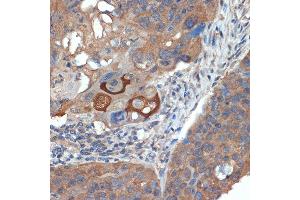 Immunohistochemistry of paraffin-embedded human esophageal cancer using CR Rabbit mAb (ABIN7266269) at dilution of 1:100 (40x lens).