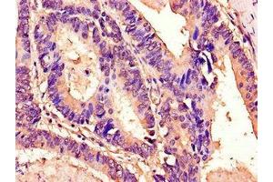 Immunohistochemistry of paraffin-embedded human colon cancer using ABIN7172930 at dilution of 1:100 (Tetraspanin 7 anticorps  (AA 114-184))